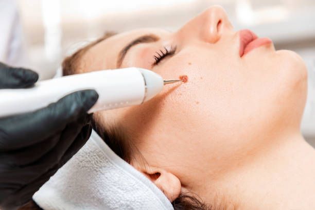 Ablations Cutanées